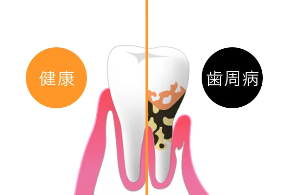 歯周病の予防