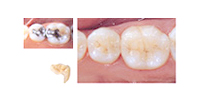 天然歯とほとんど見分けのつかない配色のセラミックで修復。
