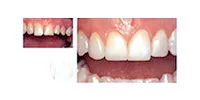 歯がかけたり、歪んでしまった歯もセラミックベニアで見た目を美しく修復。