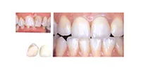 噛み合せも悪く虫歯になってしまっている歯もセラミッククラウンで見た目を美しく回復。
